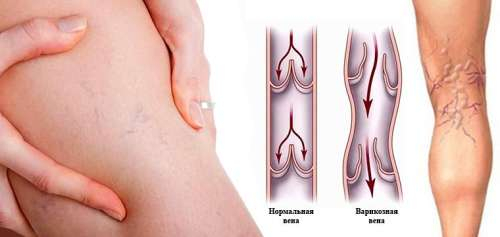 УЗИ вен нижних конечностей УЗИ вен нижних конечностей